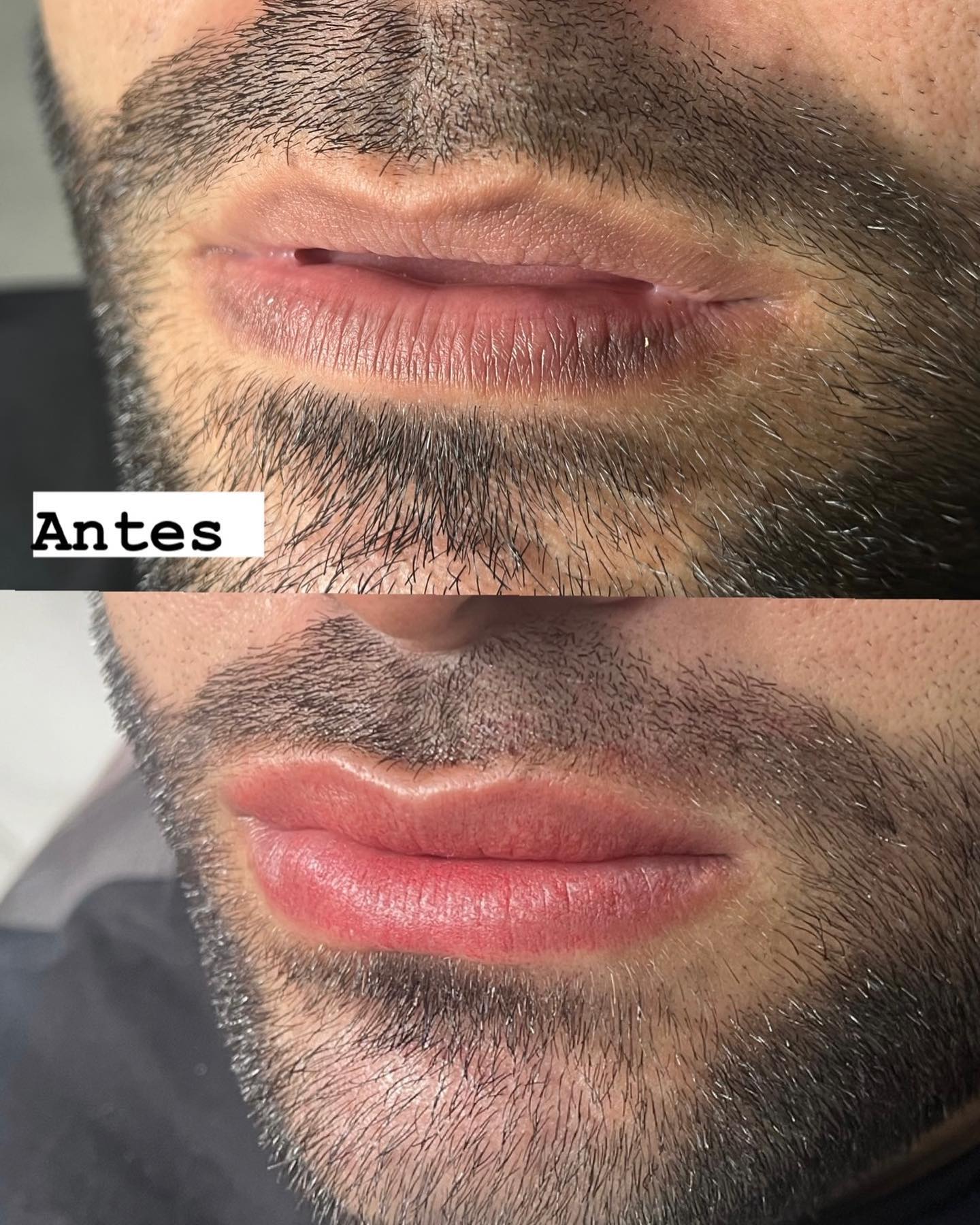 Resultado de micropigmentaci&oacute;n de labios en Sector Estadio - Pigment Pro